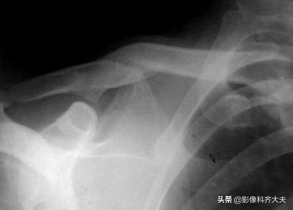 骨折的影像学检查及各自的优势,骨折的影像学愈合标准