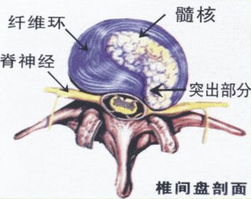 腰椎间盘突出脱出膨出的区别,腰椎间盘膨出和突出的中医治疗