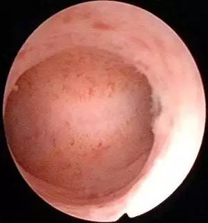 子宫里放避孕器好不好,在子宫里放治疗环