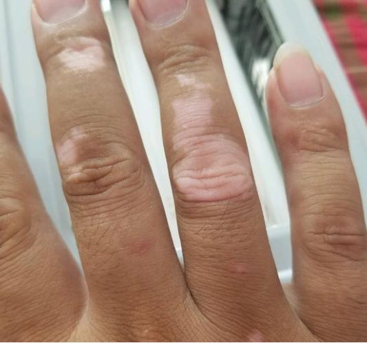 照308后发红出现水泡多久可以恢复,308照光后不红