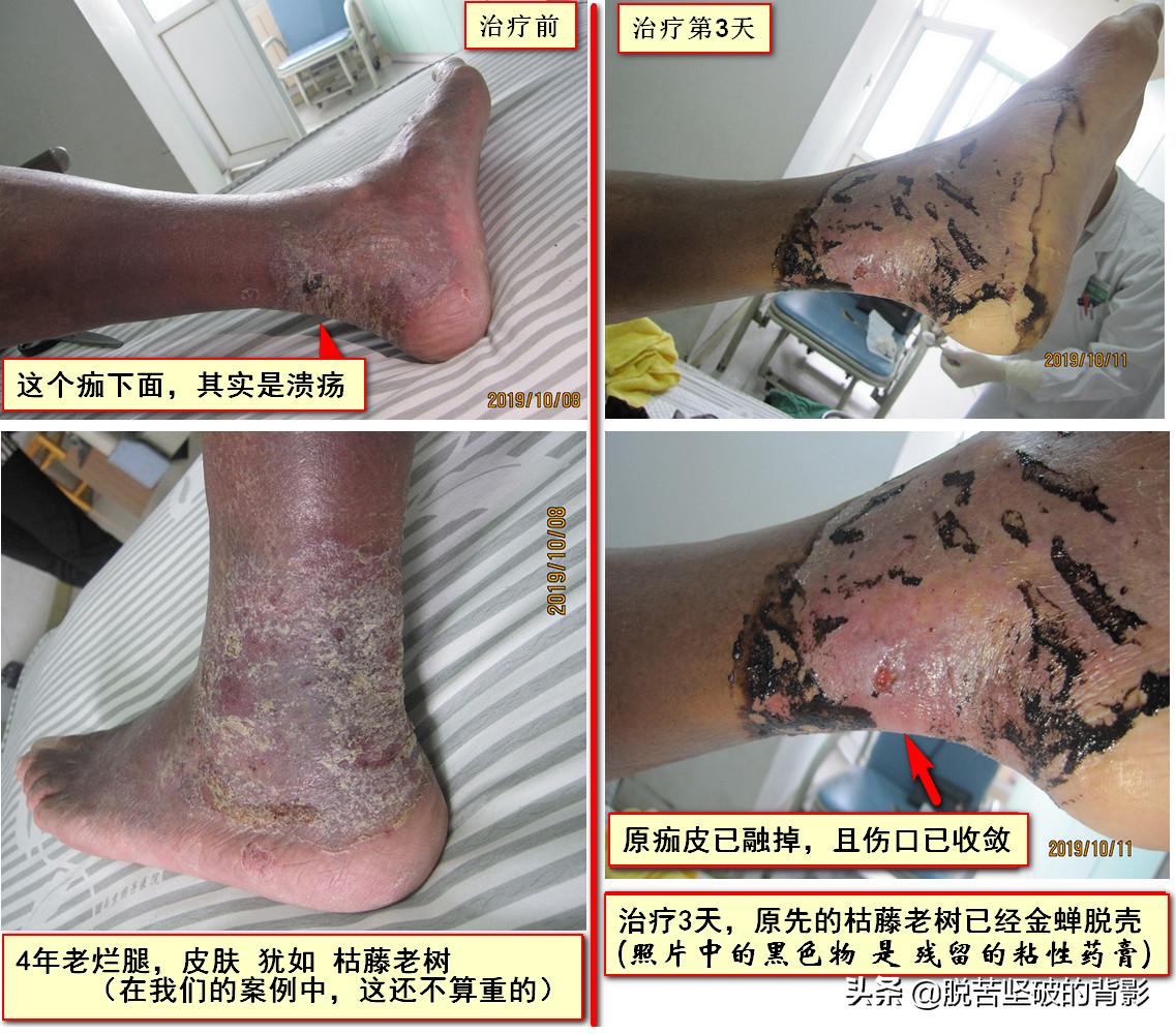 小小外伤4年8次住院，三甲医生举案说法：健康无小伤，手术须慎行