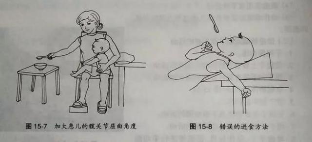 脑瘫儿童做康复的视频,脑瘫儿康复成功案例