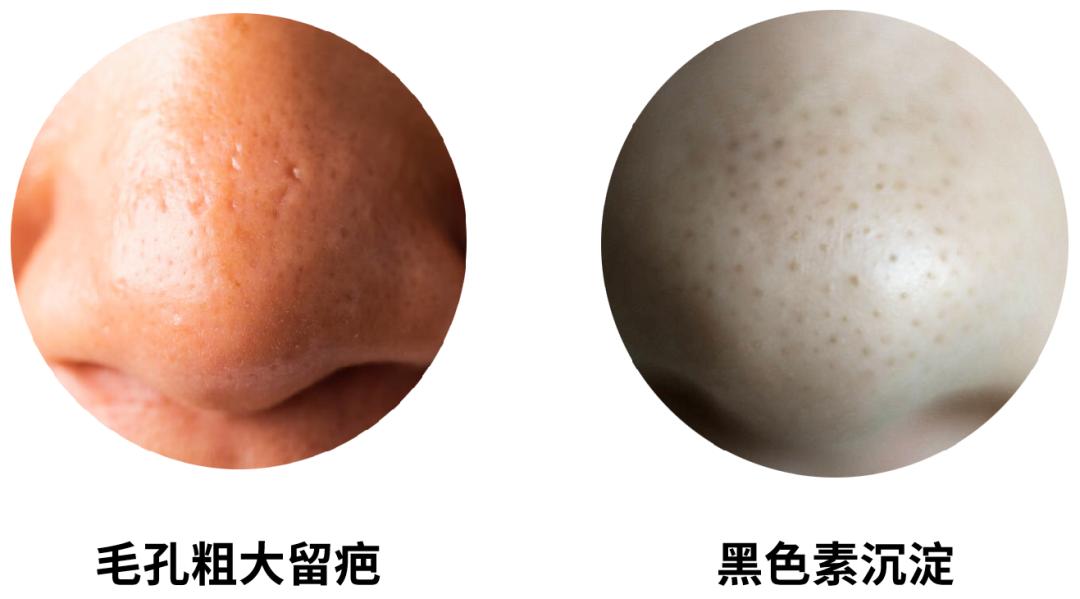 黑头毛孔粗大真的没有办法解决吗,黑头很严重毛孔粗大怎么办