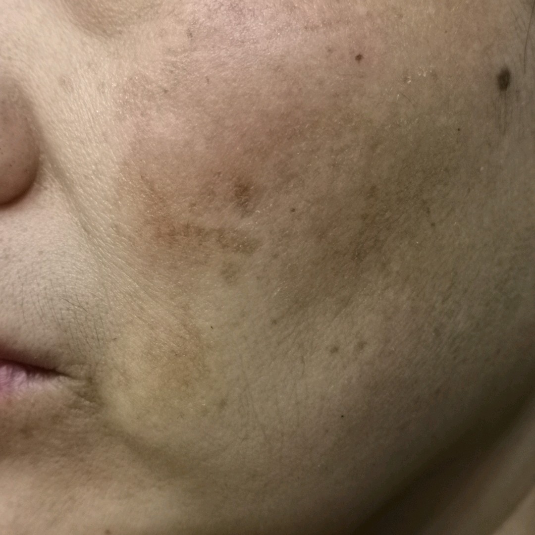 冬季护肤之祛斑正当时——光电治疗