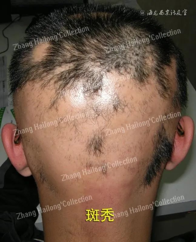 托法替尼治疗斑秃,斑蝥治疗斑秃配方