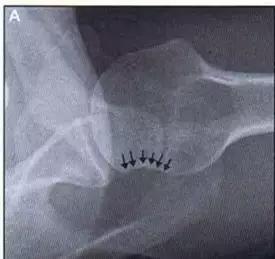 特殊骨折类型,特殊骨折体征