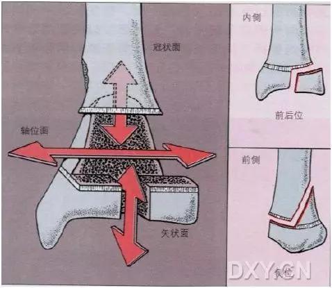 特殊骨折类型,特殊骨折体征