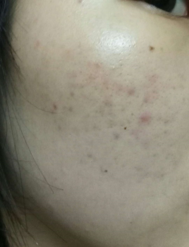 祛痘历程,祛痘经历