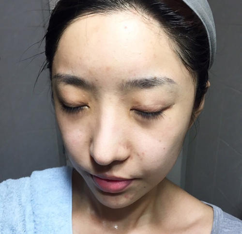 清理毛囊油脂疏通毛孔的洗发水,油脂分泌旺盛导致毛孔堵塞长痘痘