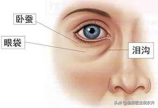 眼袋泪沟怎么解决最有效,眼袋有泪沟怎么治好得快