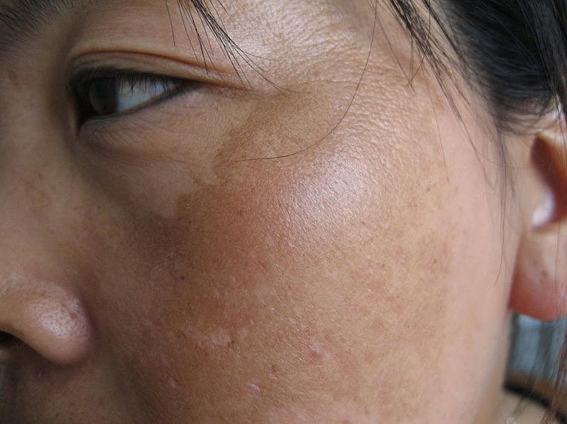 30岁以后脸上有斑怎么护理,怎样区分脸上的是斑还是痣