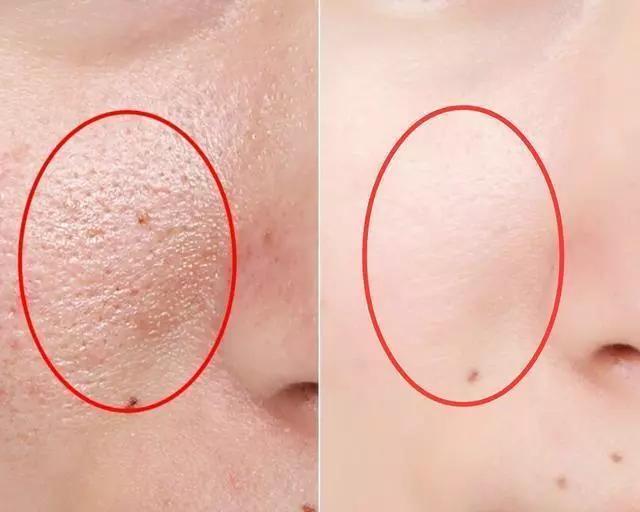 收缩毛孔告别五大误区,收缩毛孔的四大禁忌