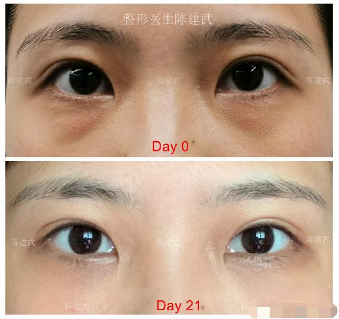 眼袋泪沟黑眼圈整形,24岁眼袋泪沟怎样去除最彻底