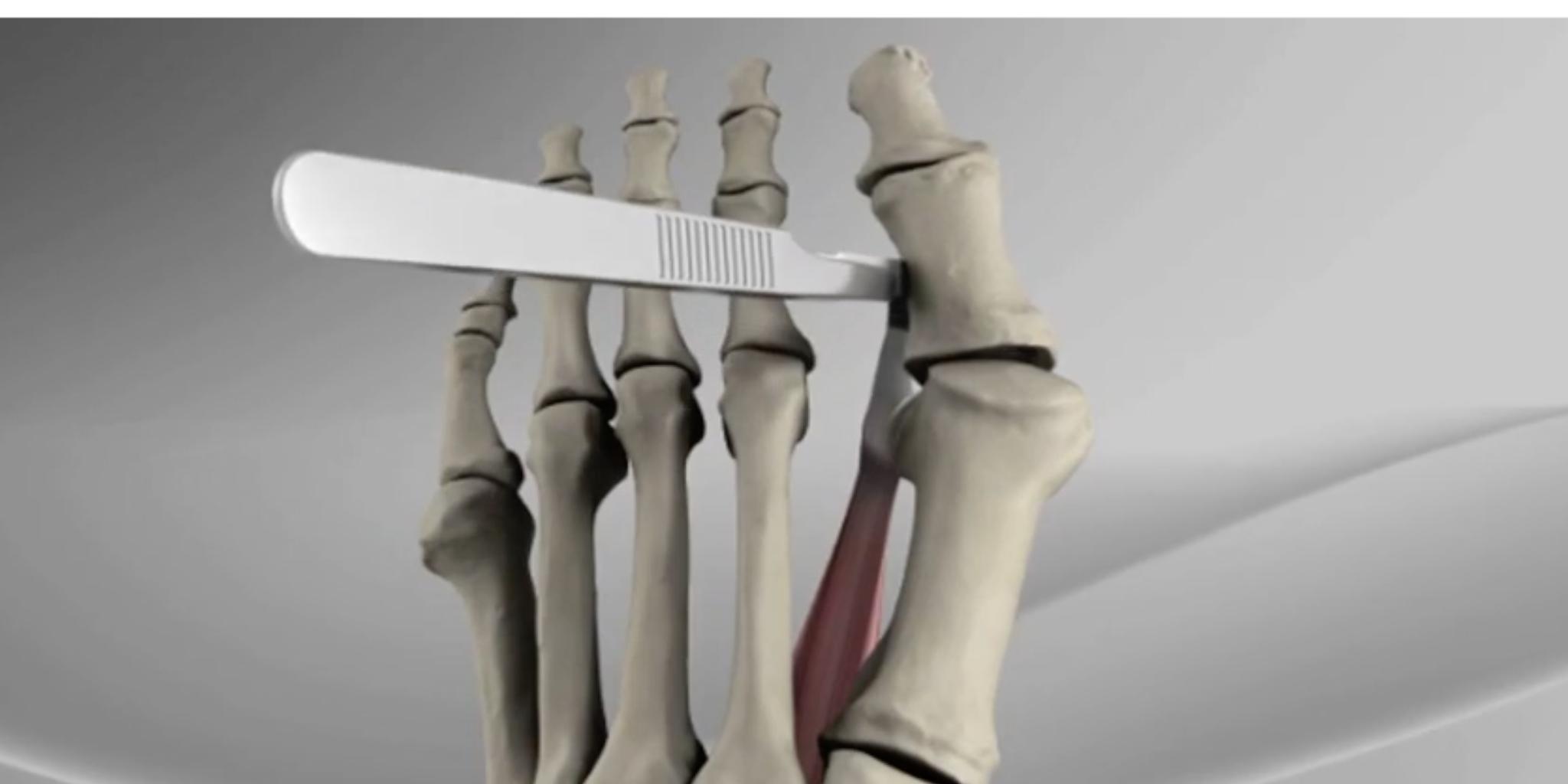 大脚骨手术的方法有几种呢,大脚骨手术了有后遗症吗能治好吗