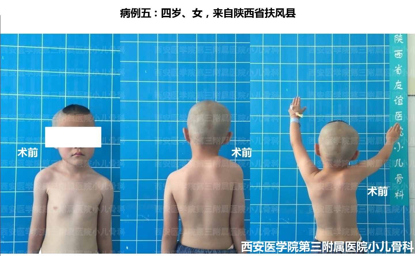 先天性高肩胛手术,先天性肩胛症通过手术需要多少钱