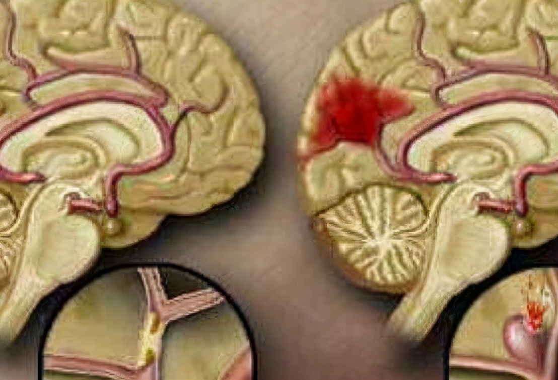 高血压导致脑出血怎么救治,高血压脑出血应该如何救治