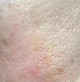 吸黑头神器去粉刺角质收缩毛孔,皮肤清洁收缩毛孔黑头角质