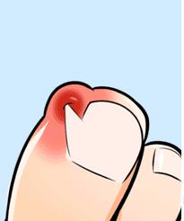 甲沟炎挤出血是什么现象,甲沟炎是剪指甲太深引起的吗