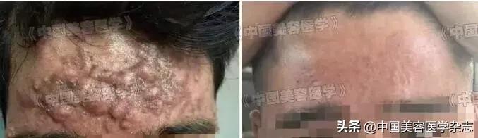 不怕人设崩塌，就怕皮肤太差！治疗重、中、轻*疮痤**临床论文分享！