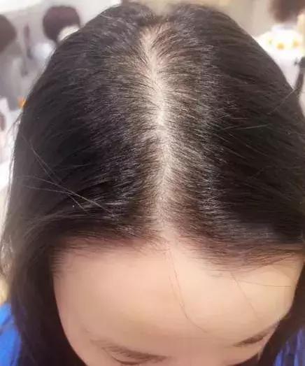 头发毛躁并且脱发推荐洗发水,用什么洗发水改善头皮脱发