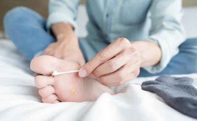 脚气足癣怎么治疗最有效,香港中医治疗脚气的偏方