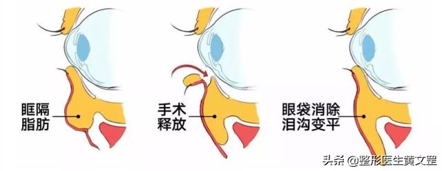 有了泪沟怎么消除,改善显老泪沟试试这3种方法