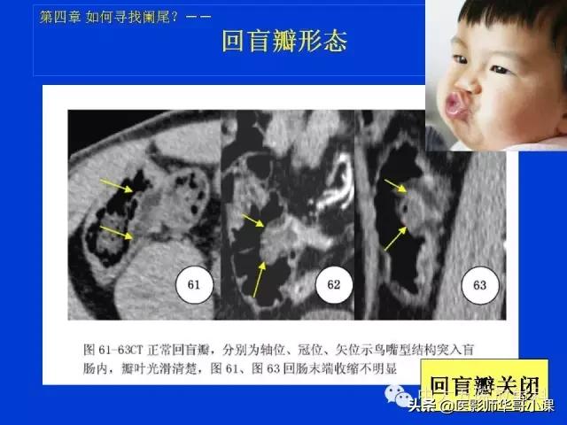 阑尾炎课件,阑尾炎的超声课件