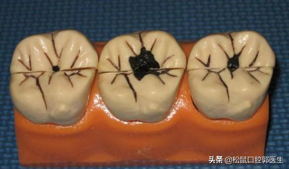 怎样判断自己有蛀牙,怎样判断自己有没有蛀牙