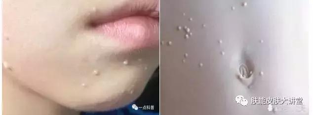 传染性水瘊子图片,水瘊子和传染性软疣一样吗