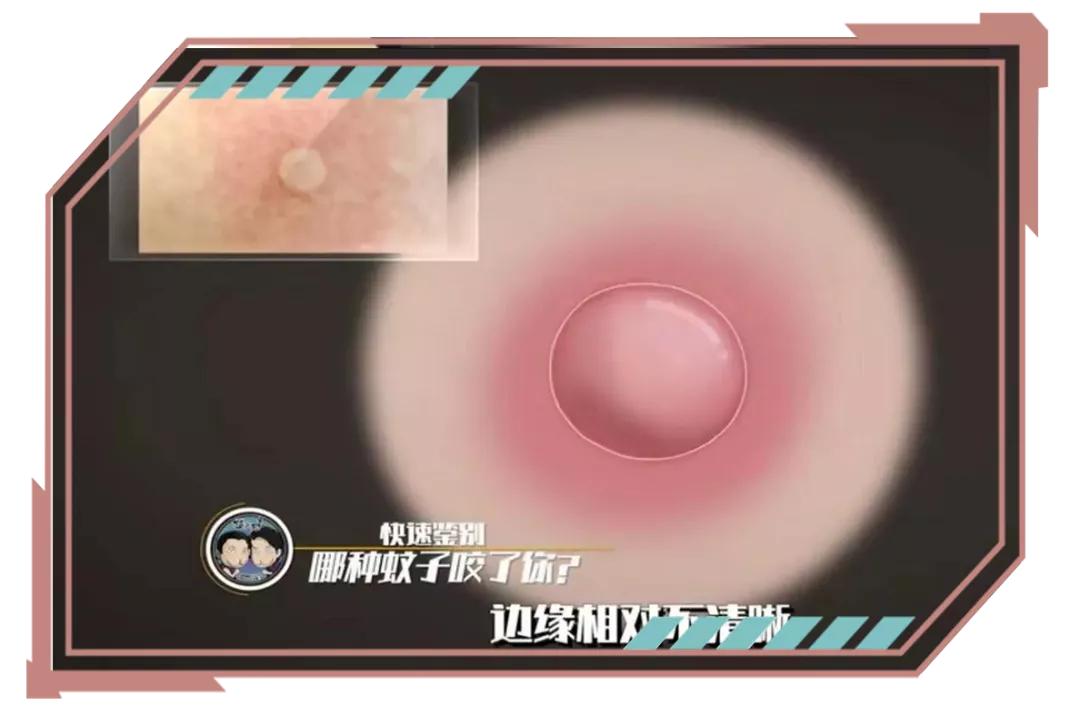 睡觉被咬了个包痒肿,手掌被咬了个包又痒又疼