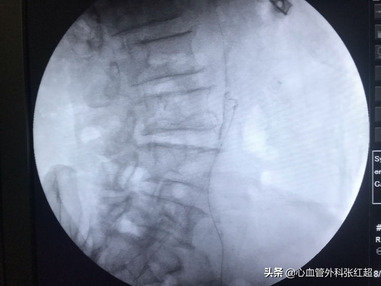 外周血管治疗图,外周血管疾病怎么治