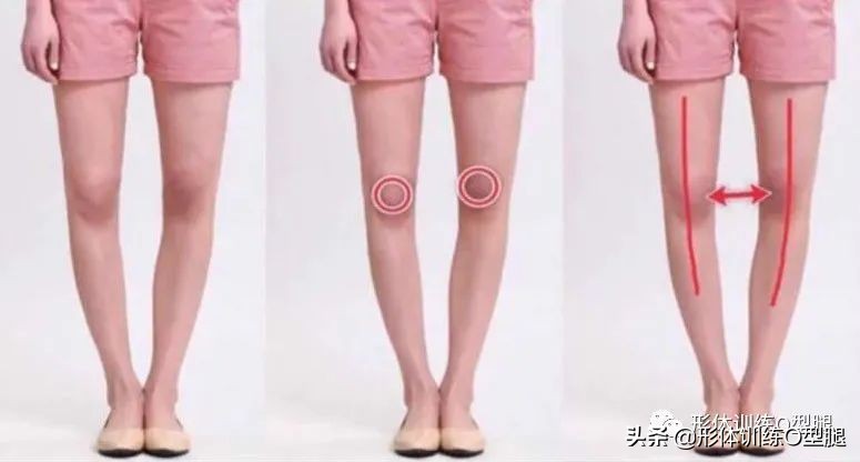 怎样矫正o型腿罗圈腿,罗圈腿和o型腿是怎么形成的