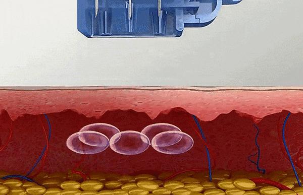 医生不会告诉你的医美危害,为什么医生不建议做水光针
