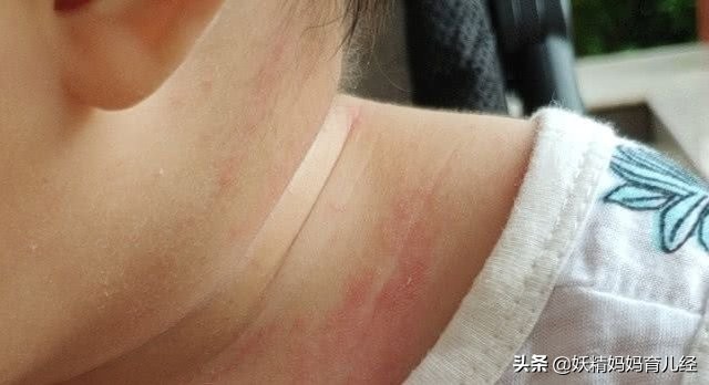 痱子用痱子粉还是痱子粉,宝宝痱子粉用什么方法可以去除