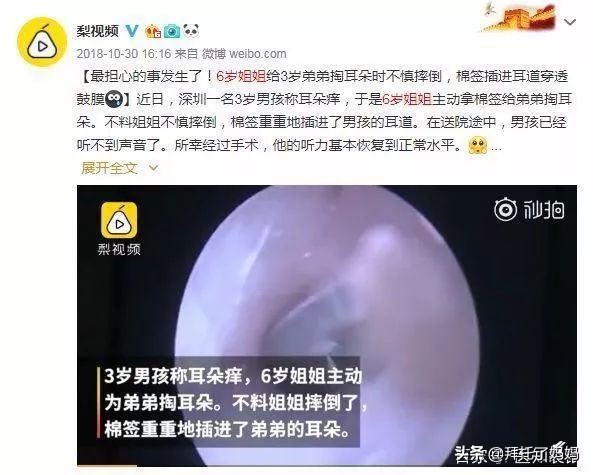 小孩长期不挖耳屎的危害,男童4年没有挖耳屎