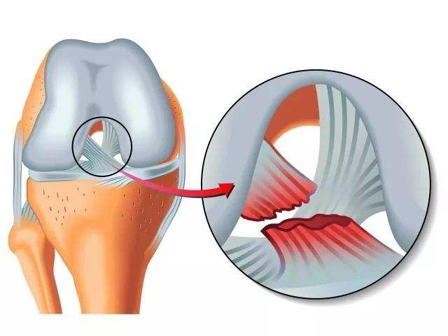 膝关节前叉韧带损伤最佳恢复方法,膝关节前韧带断了必须手术吗