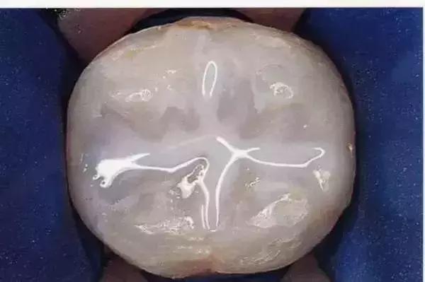 做父母的要懂得管教,窝沟封闭值得做吗