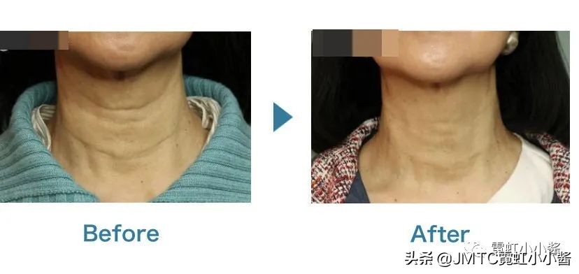 25岁抗老拯救垮脸,哪种脸型抗衰抗皱