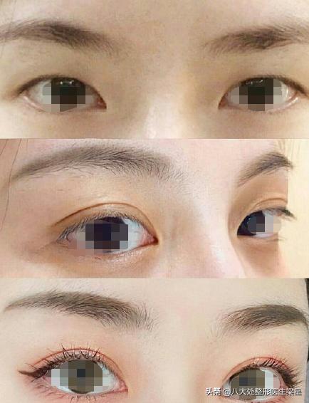双眼皮手术开眼角恢复过程,双眼皮全切开眼角恢复期图