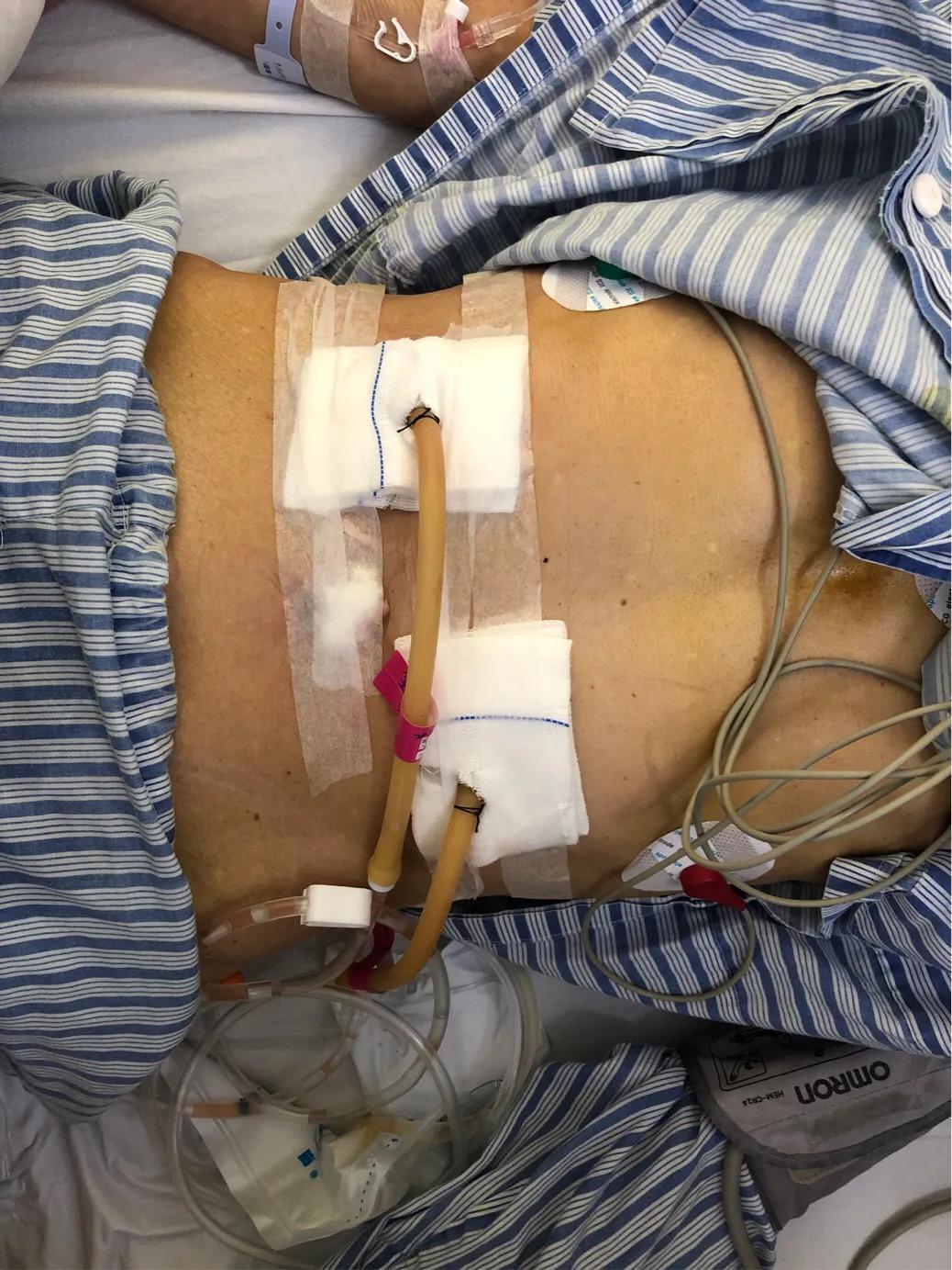 消化道穿孔会腹痛怎么办,肚子痛消化道穿孔