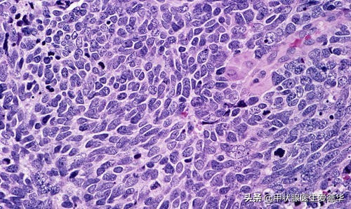 保守治疗好还是做化疗好,甲状腺髓样癌不治疗能活多久