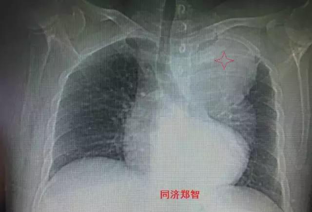 磁共振可以替代cta检查主动脉夹层,超声心动图联合cta诊断主动脉夹层