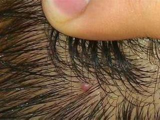 为什么鼻翼两侧发红还长痘,为什么会鼻翼两边泛红发痒