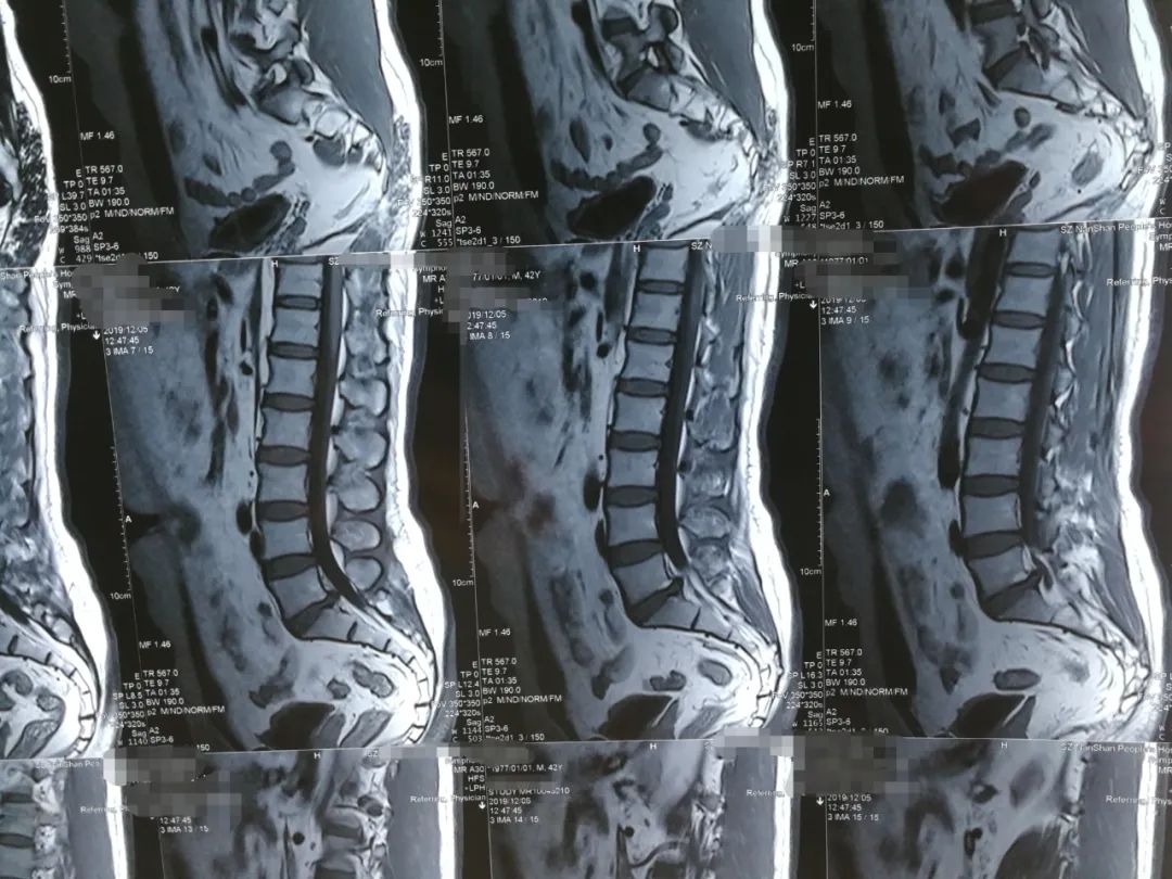 腰椎间盘突出症治疗，1个反射动作引出，提示治愈，医生很开心