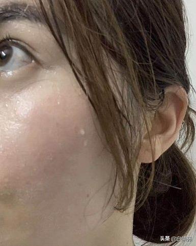 全球公认最有效的祛痘印产品,公认祛痘印最好的产品是什么