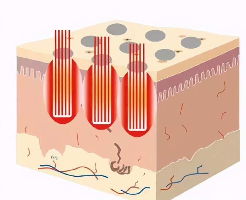 如何搞定毛孔粗大闭口粉刺,毛孔粗大痘痘粉刺统统搞定