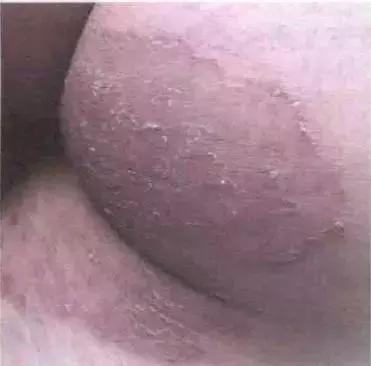 科普真菌感染性皮肤病的防治,专门治疗真菌皮肤病的药膏