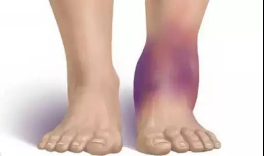 脚扭伤怎么治疗最佳方法,脚扭伤的正确处理方法