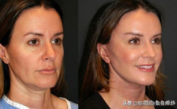 做筋膜拉皮手术效果维持多久,拉皮手术能维持几年