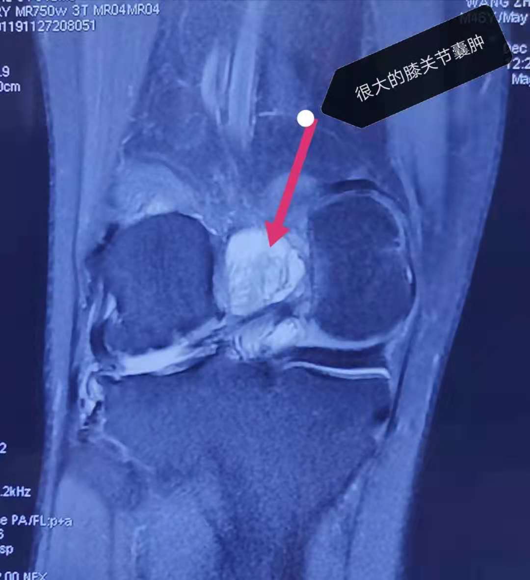半月板微创手术怕不怕,半月板手术是不是能不做就不做